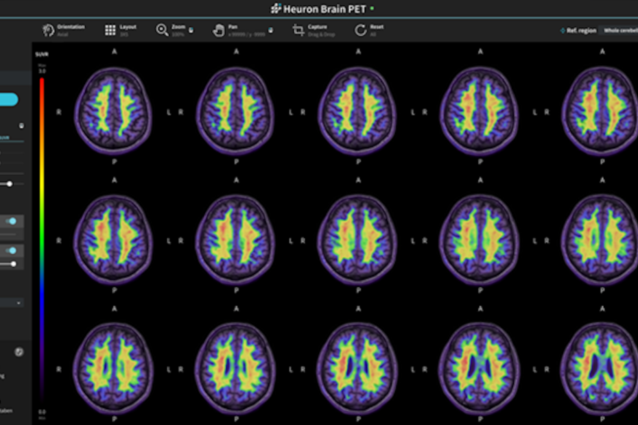 National University Hospital testing predictive AI for Alzheimer’s diagnosis and more AI briefs